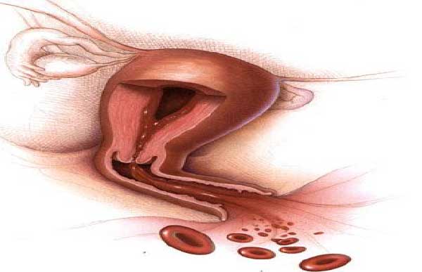 خونریزی غیر طبیعی واژن